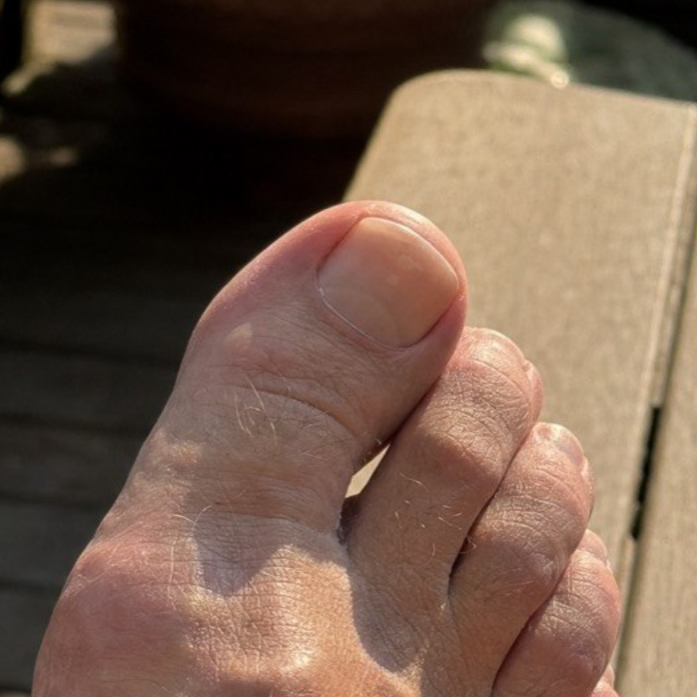 Nail after completing the protocol
