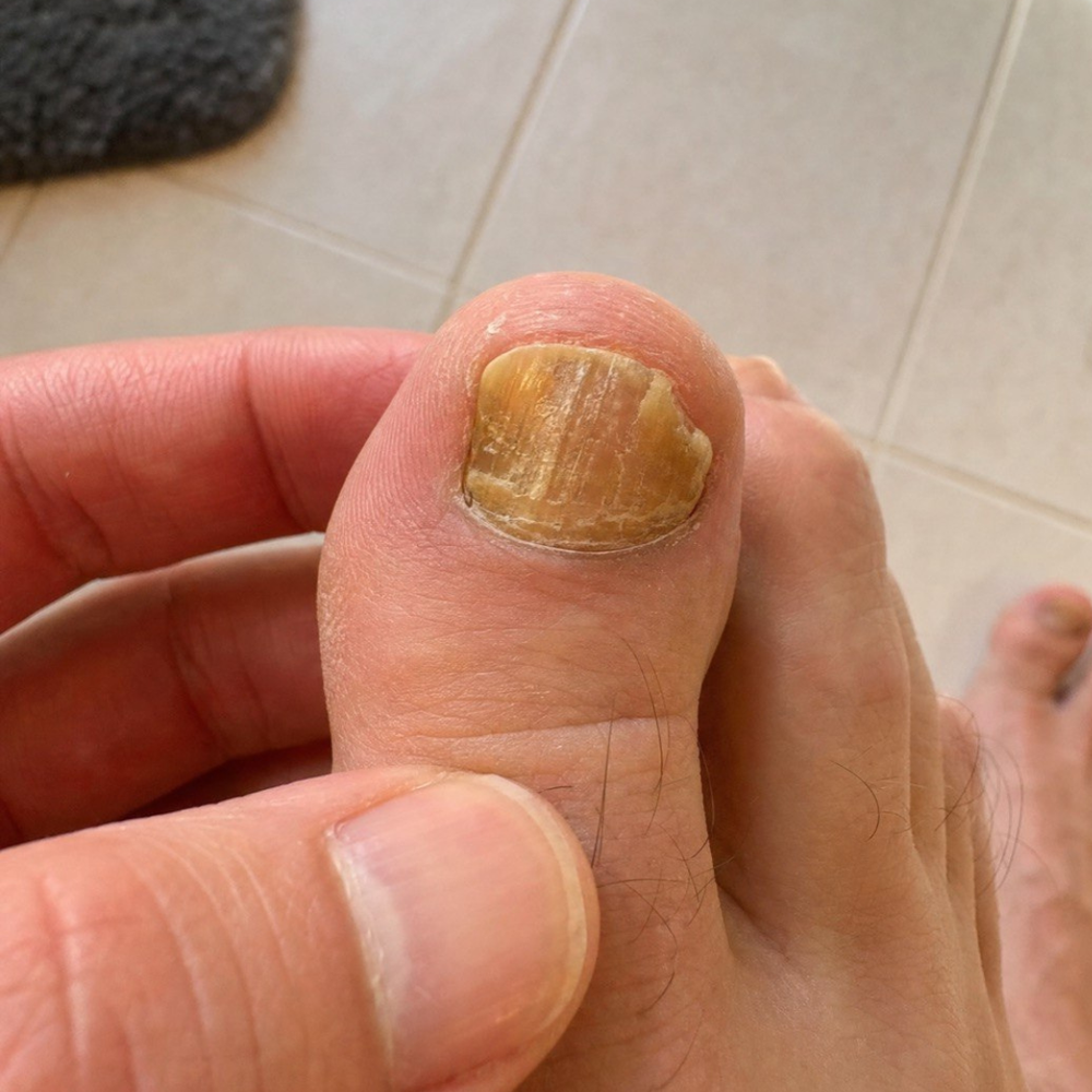 Nail before beginning the protocol